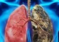 Un síntoma del cáncer de pulmón que podría esconderse en las axilas
