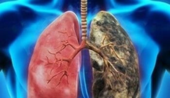 Un síntoma del cáncer de pulmón que podría esconderse en las axilas