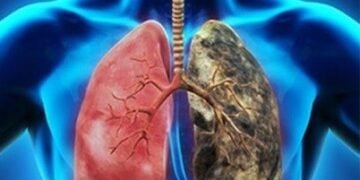 Un síntoma del cáncer de pulmón que podría esconderse en las axilas