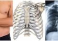 Costocondritis, implica inflamación y dolor de costillas