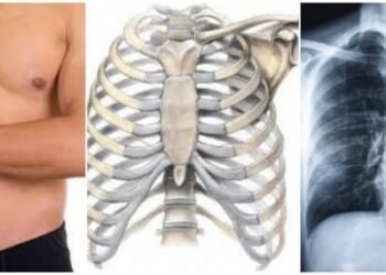 Costocondritis, implica inflamación y dolor de costillas