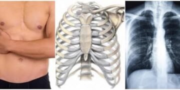 Costocondritis, implica inflamación y dolor de costillas