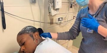 Mujer que se fijó el pelo con pegamento tendrá que operarse