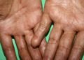La sarna o escabiasis es una afección que tiene cura