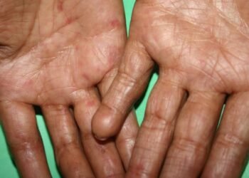 La sarna o escabiasis es una afección que tiene cura