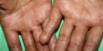 La sarna o escabiasis es una afección que tiene cura