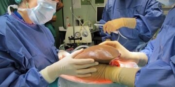 Exitoso trasplante hígado humano tratado 3 días fuera del cuerpo
