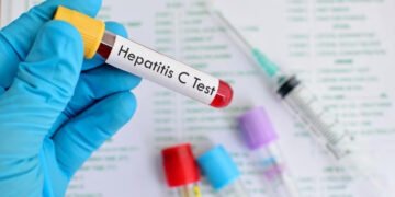 Hepatitis, más letal que la malaria, la tuberculosis y el sida