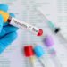 Hepatitis, más letal que la malaria, la tuberculosis y el sida